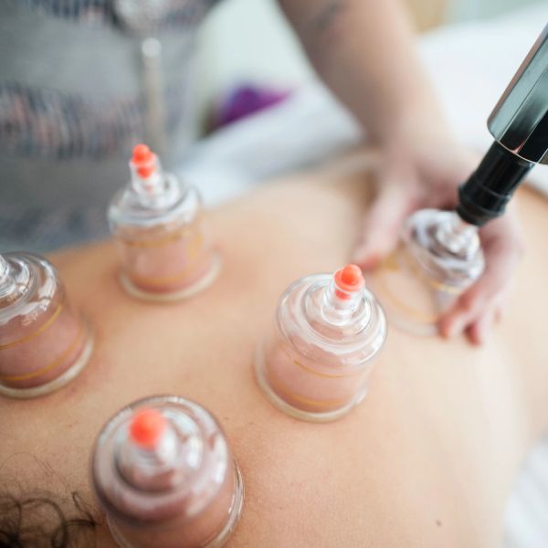 Cupping therapy being performed on a person's back.