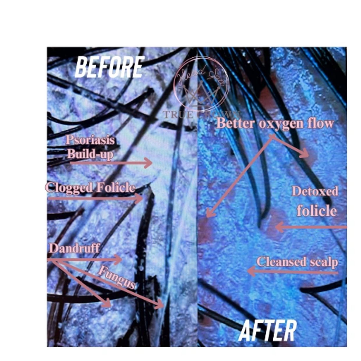 Before and after scalp treatment showing clogged follicles and dandruff cleared.