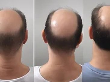 Stem Cell Therapy for hair loss