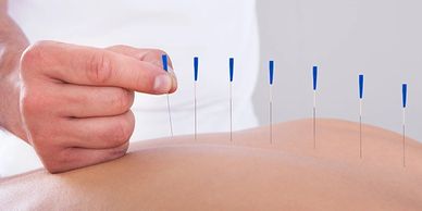 Acupuncture