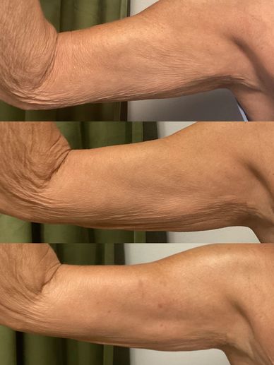 Noticeable tightening and enhanced skin elasticity in the arms after just one treatment.