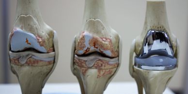 Knee arthritis, Orthopaedic surgeon Dr David Drynan will help treat you in an evidence based fashion