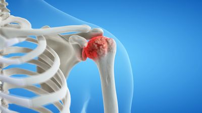 Left shoulder osteoarthritis, cartilage damage and degeneration.