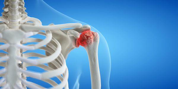 Shoulder arthritis
for a total shoulder replacement
