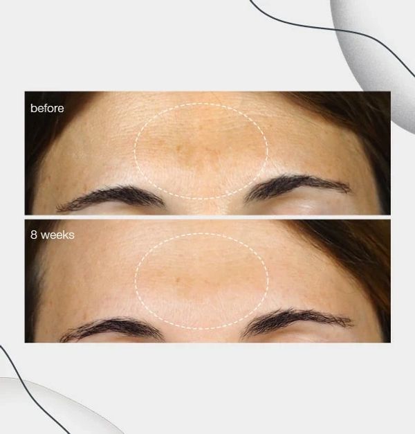 Before and after forehead skin improvement over 8 weeks.