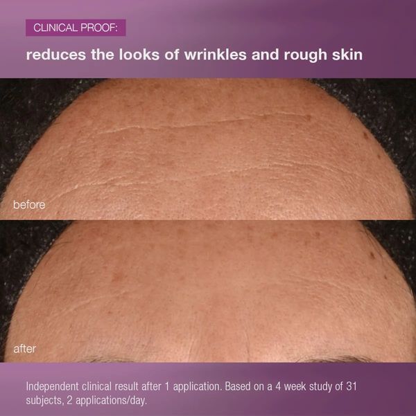 Before and after images showing reduced wrinkles on forehead.
