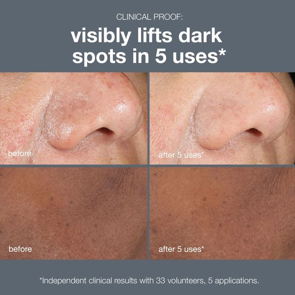 Before and after images showing visible reduction of dark spots after 5 uses.
