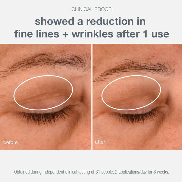 Before and after images showing reduced fine lines and wrinkles.