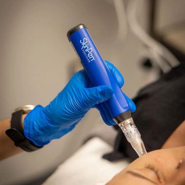 Close-up of a skincare pen being used on a person's face.