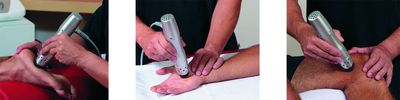 Extracorporeal Shockwave Therapy at Federico Physical Therapy