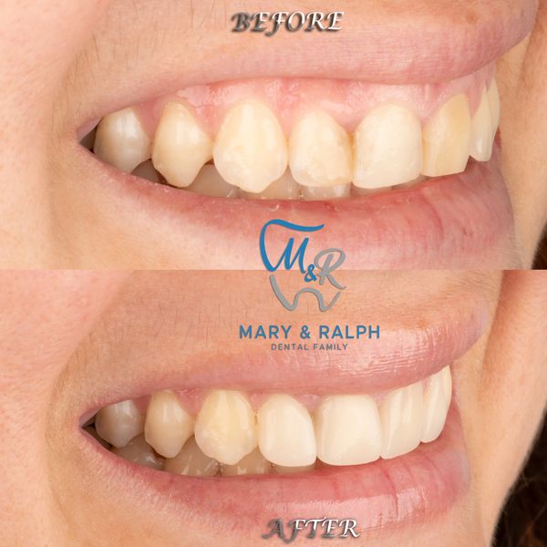 Dental veneers
