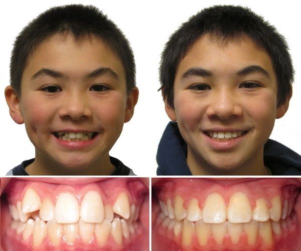 Affordable Braces - Gentle Care Dental