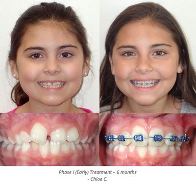 Kids Braces  Why is Early Dental Intervention Important?