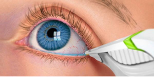 Tear Lab Eyecare Experts Dry Eye Center