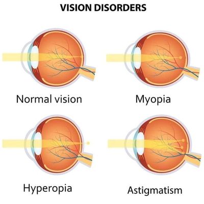 nearsighted vs farsighted lens