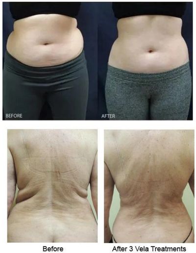 Before and after photos showing body contour improvements after Vela treatments.
