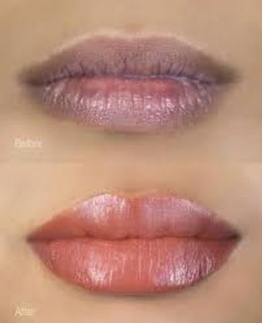 Lip Pigment Neutralization