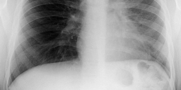 chest xray