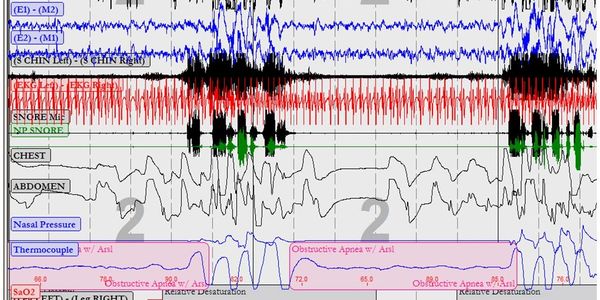 sleep studies