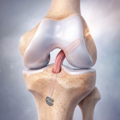 Illustration of a knee joint with an ACL reconstruction surgery.