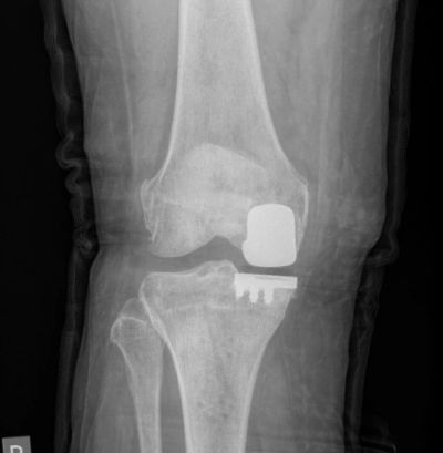 Partial Knee Replacement Unicompartmental Knee Replacement Dr Borshch Hamilton Brisbane