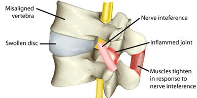 Vertebral Subluxation
