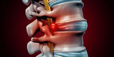 Decompression therapy, or spinal decompression is a highly effective in reversing the pain caused by