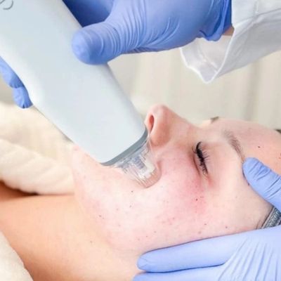 Potenza RF Microneedling