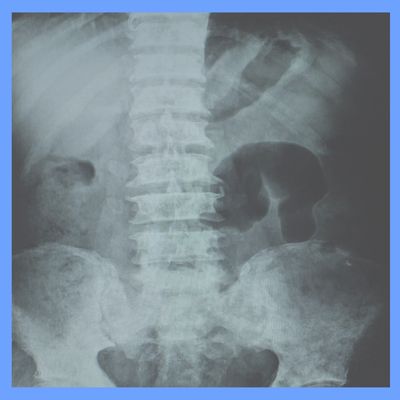 X-Ray showing spine and hips with a slipped and fractured vertebra