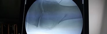 C Armview of genicular Radiofrequency cannula placement 