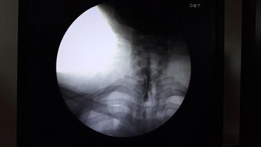 Cervical Epidural MIPSI for cervicobrachialgia 