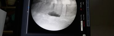 Lumbar Sympathectomy for Buergers Disease
