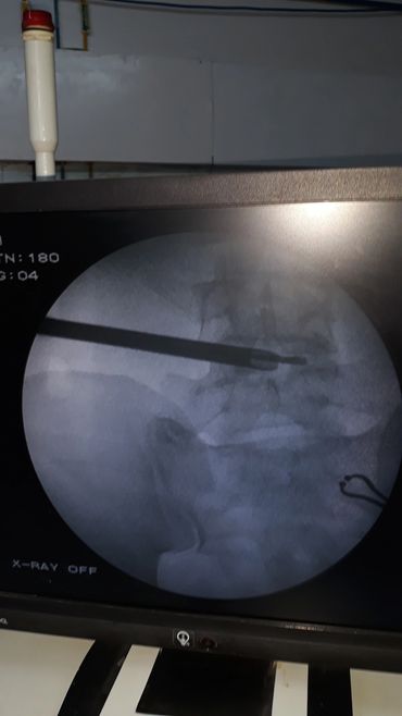 Endoscopic Discectomy at L4-5 levl