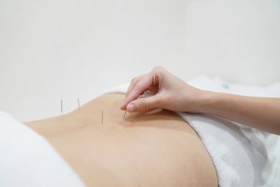 针灸治疗腰部。
