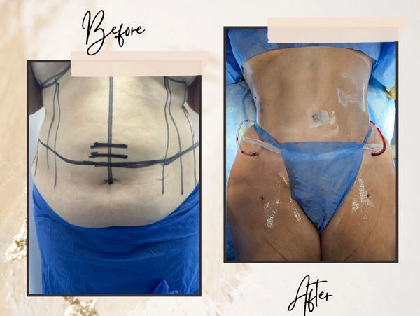 crown abdominoplasty. with back liposuction شد البطن التاجي مع نحت الخصر و الظهر مع الدكتور مجدي الف 