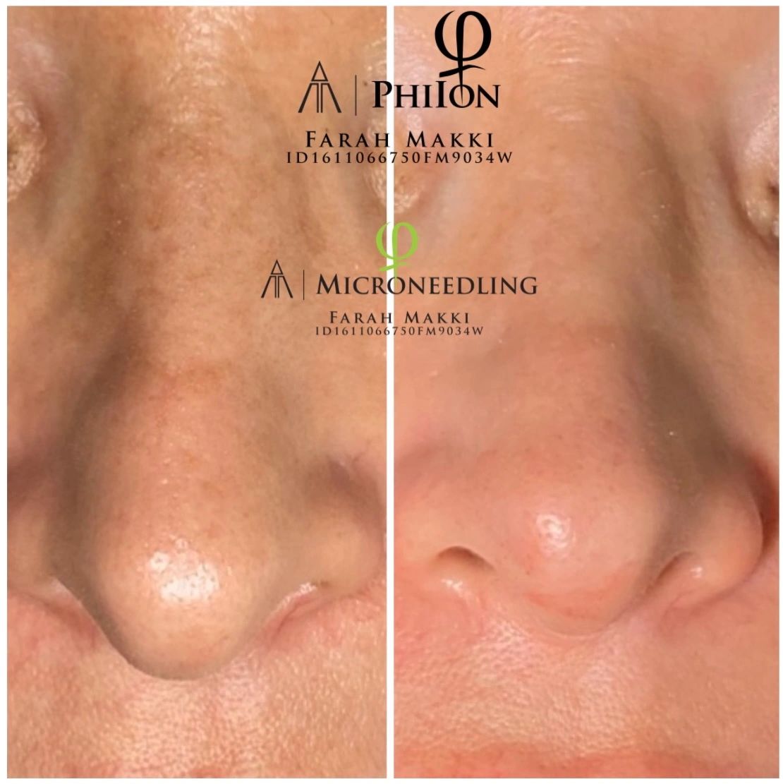 Microneedling 