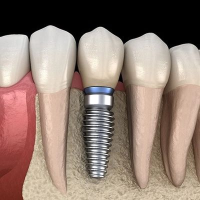picture of an implant of a tooth