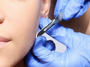 manual exfoliation, using a scalpel blade to remove the dead skin and hair from the face 