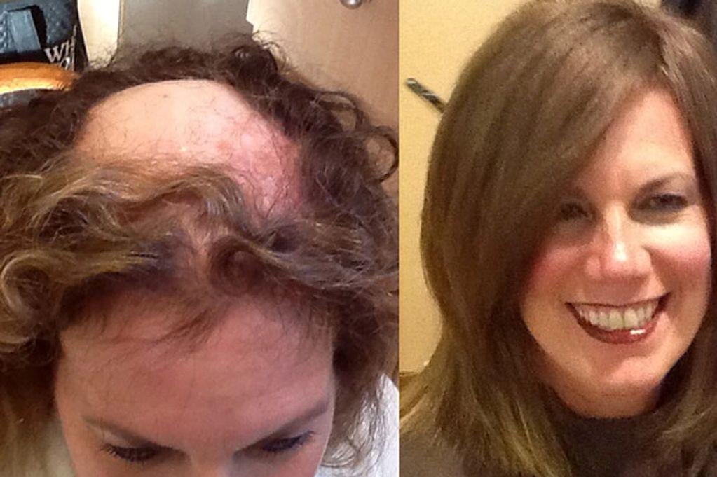 Before and after picture of a woman wearing a hair system