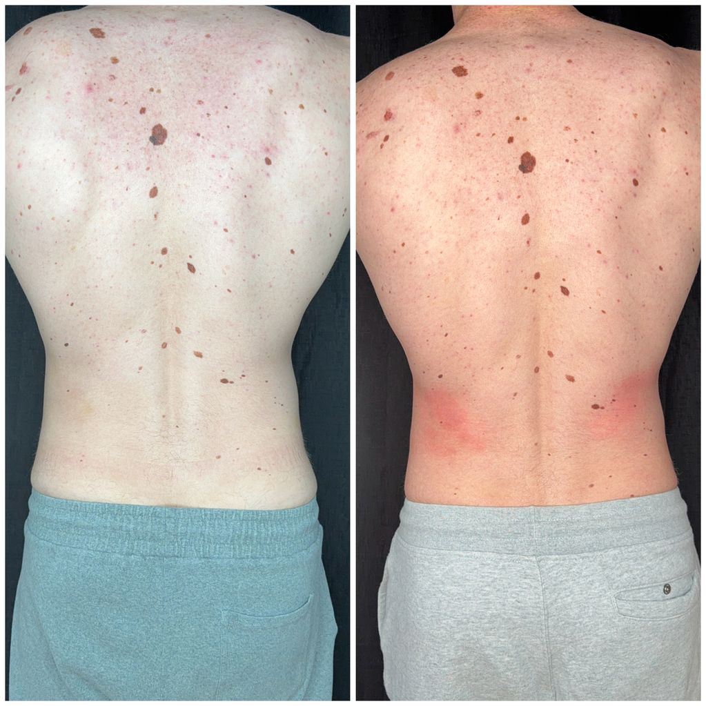 Body contour, refinement flanks