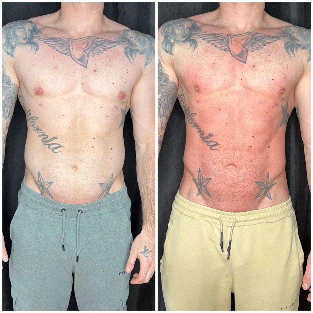 Body contour refinement chess, abdomen, and obliques