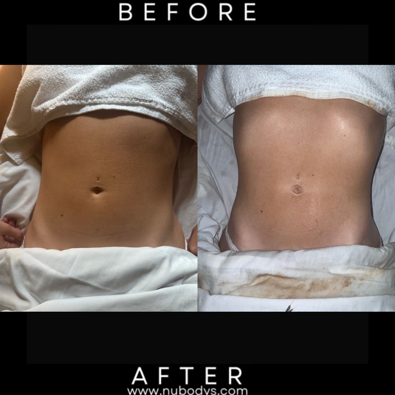 Flush Fat with Lymphatic Massage