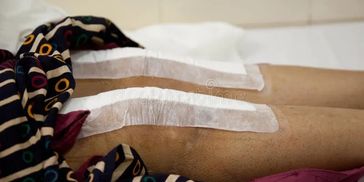 Post Surgical Rehabilitation