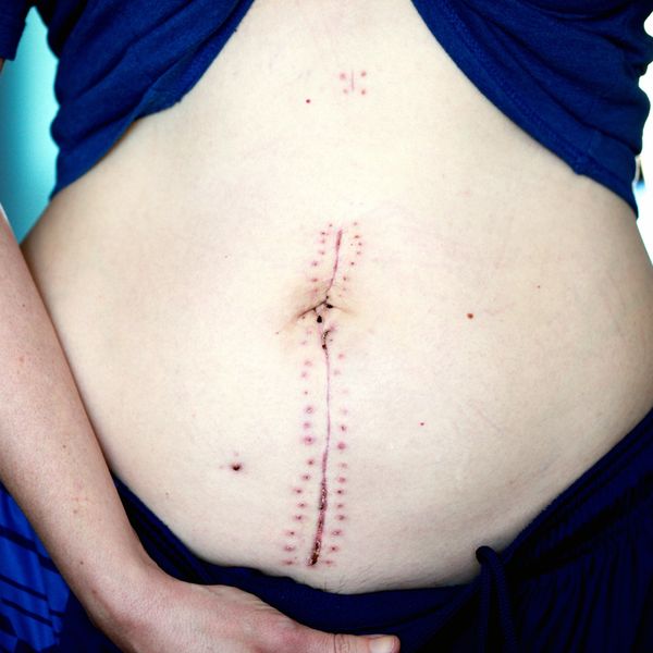 Abdominal surgery scarring