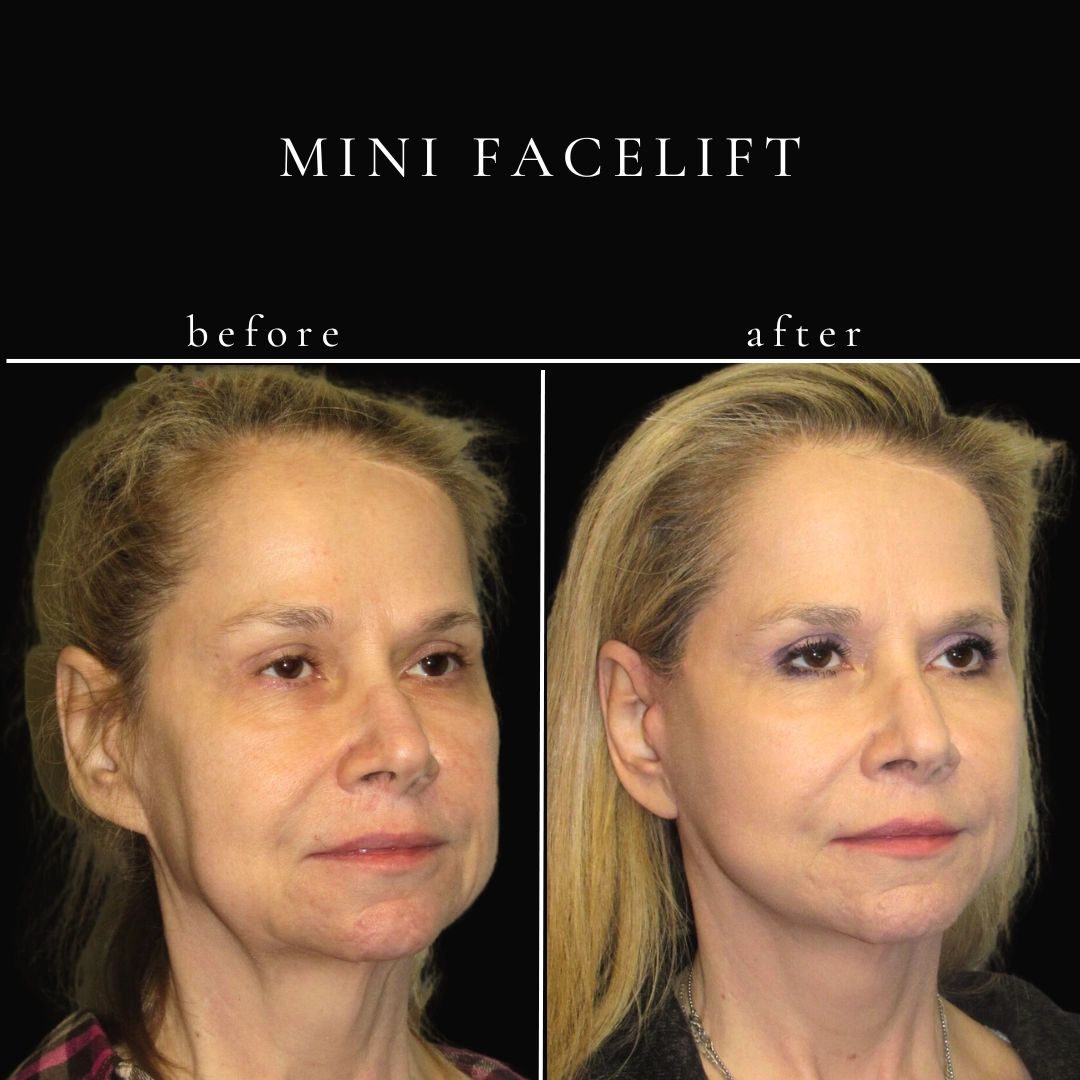 Mini Facelift Near Me Options Explained