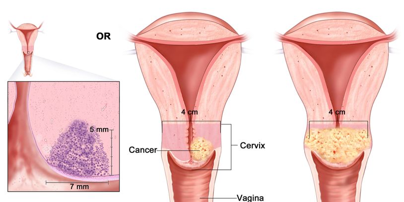 cervical cancer, pap smear, uterine bleeding, vaginal bleeding, pelvic ultrasound, ultrasound