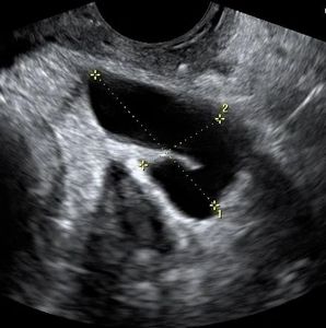 fertility, infertility, hydrosalpinx, blocked tube, pregnancy, ultrasound, pelvic ultrasound