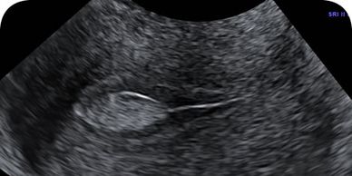 endometrial polyp, vaginal bleeding, uterine bleeding, ultrasound, London, gynaecologist,gynecology