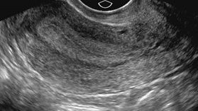 Cancerul endometrial: diagnostic și tratament - Endometrial cancer premenopausal