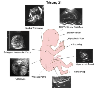 Potential ultrasound markers of trisomy 21 (Down syndrome)
